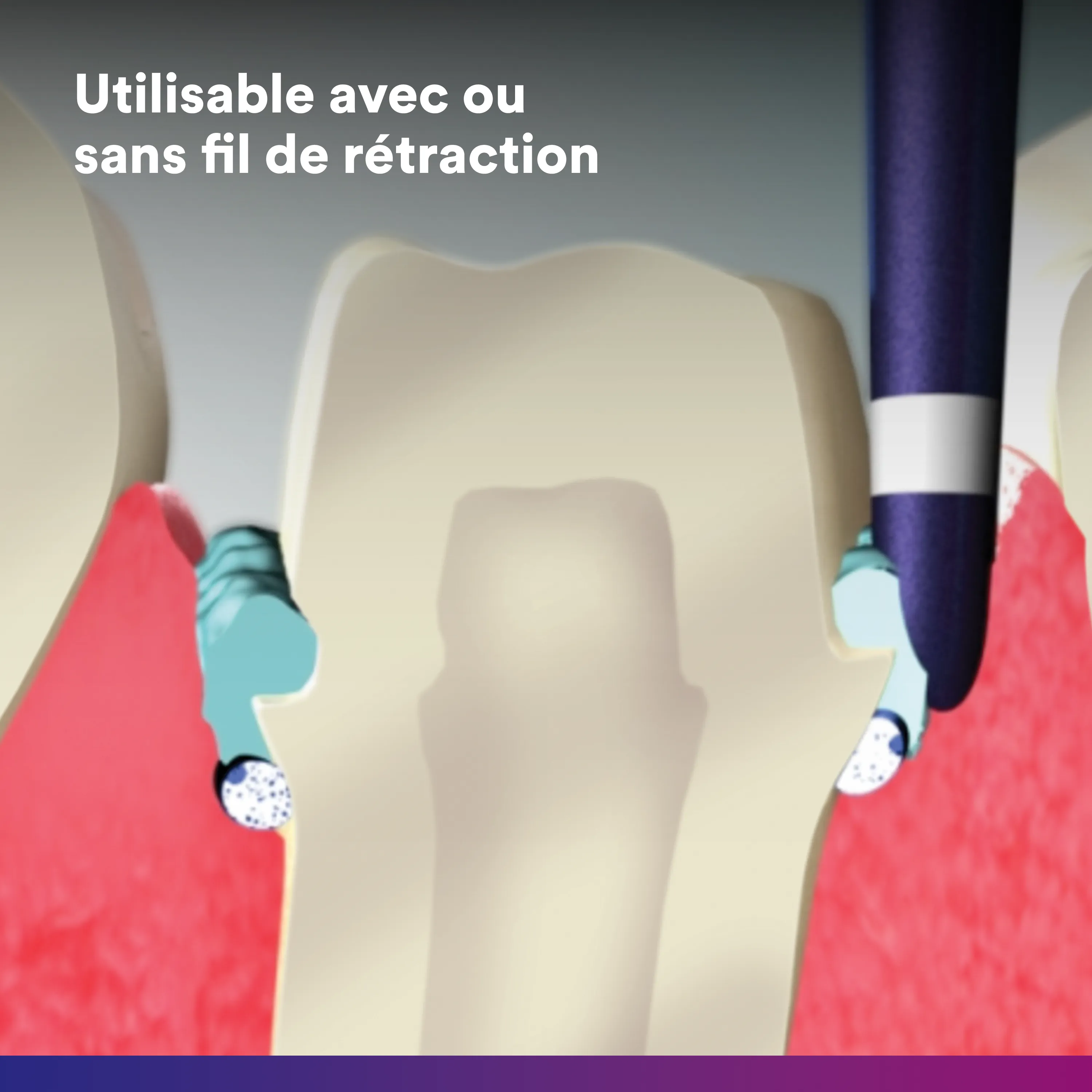3M™ ARP Cap Pâte de rétraction gingivale, boîte géante 100 capsules