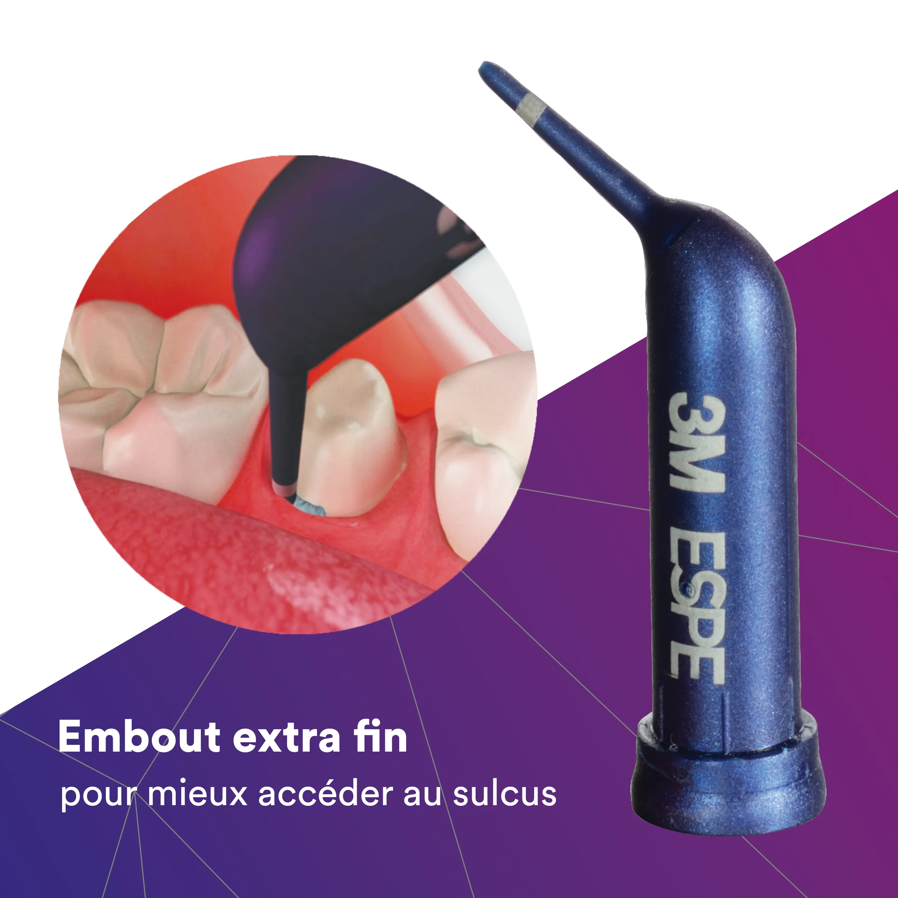 3M™ ARP Cap Pâte de rétraction gingivale, boîte standard